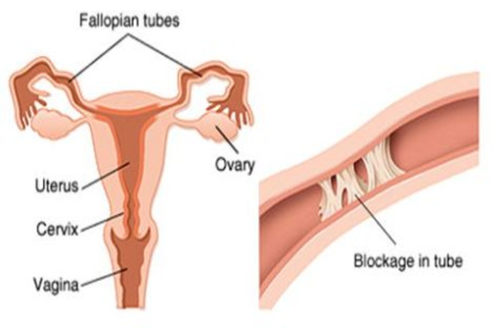 Fallopian tubes blocked