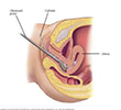 Hysteroscopy
