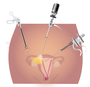 laparoscopy