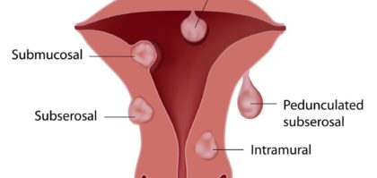 Uterine fibroids types diagram