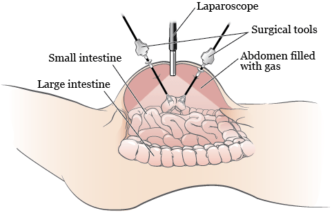 Emergency laparoscopy