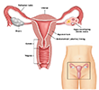 Gynaecology