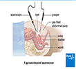 Laparoscopy in Pregnancy
